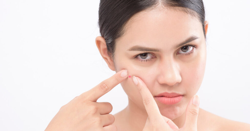 frustrated woman squeezing pimple