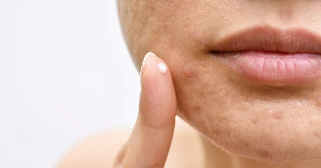 person applying treatment to acne on their face