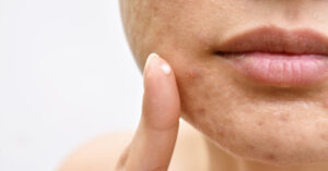 person applying treatment to acne on their face