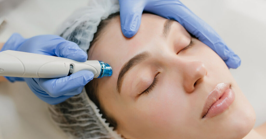 a woman is receiving a skin rejuvenating, acne fighting, micro needling treatment